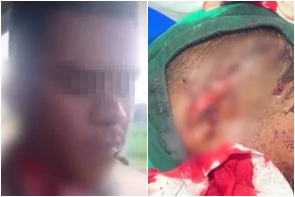 Após perder parte da orelha em briga, homem acende cigarro no bar