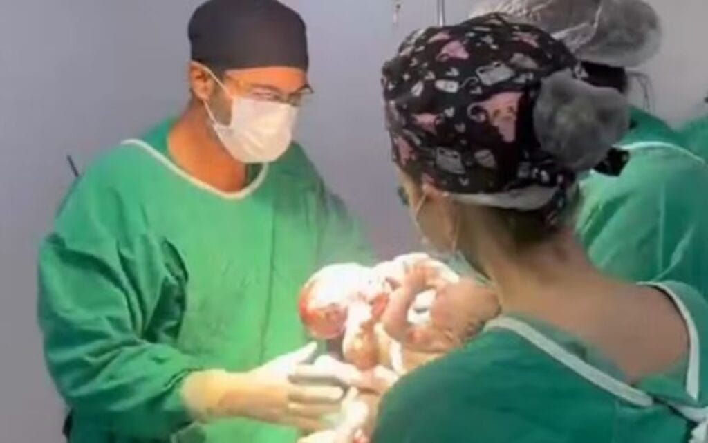 Morre Mateus após cirurgia de separação