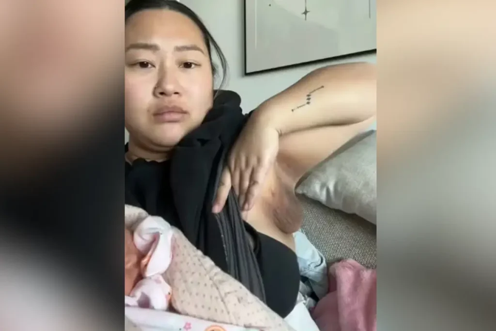 Mulher desenvolve 'terceiro seio' após dar à luz: entenda o que é a polimastia