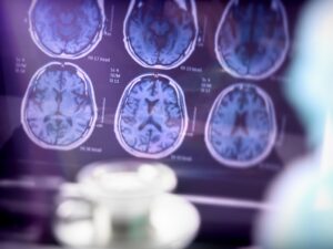 Diagnóstico precoce de Alzheimer melhora qualidade de vida de pacientes e famílias