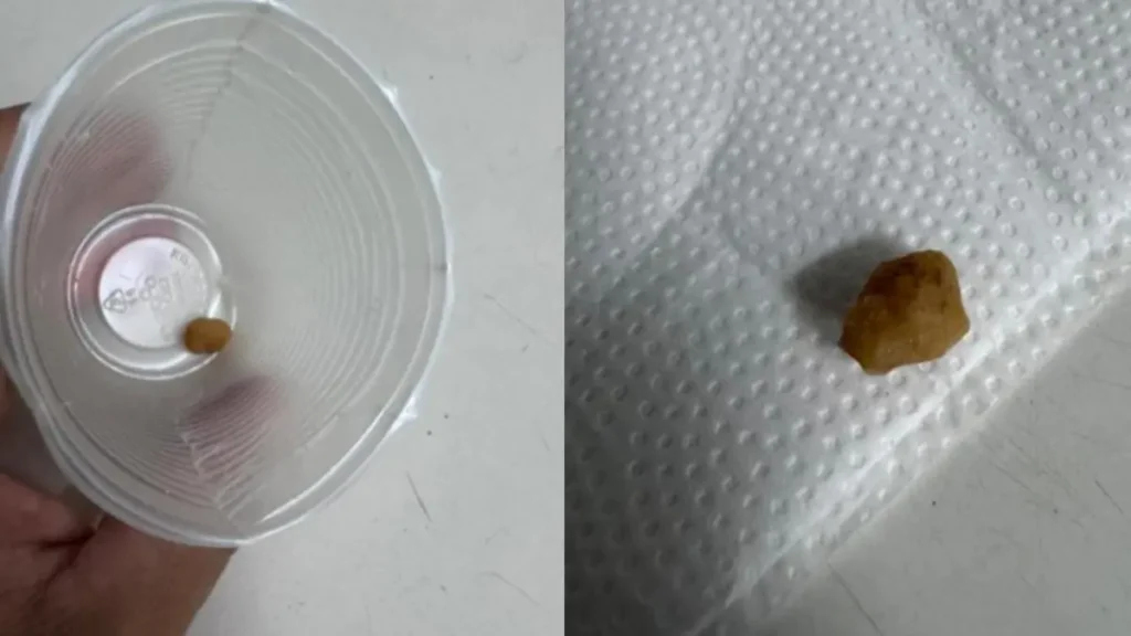 Possível pedra de crack retirada do estômago do garoto - (Foto: reprodução/PM)