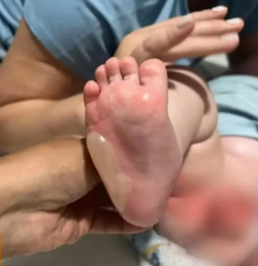 Bebê sofre queimaduras em 29% do corpo após banho em escola de Rio Verde