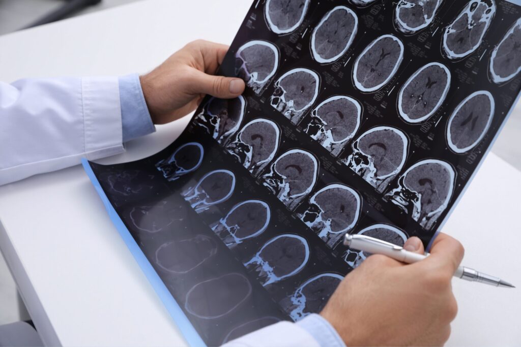Esclerose múltipla é a principal causa de incapacidade neurológica em jovens