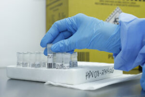 DF pioneiro em teste de DNA-HPV para rastreio de câncer de colo do útero