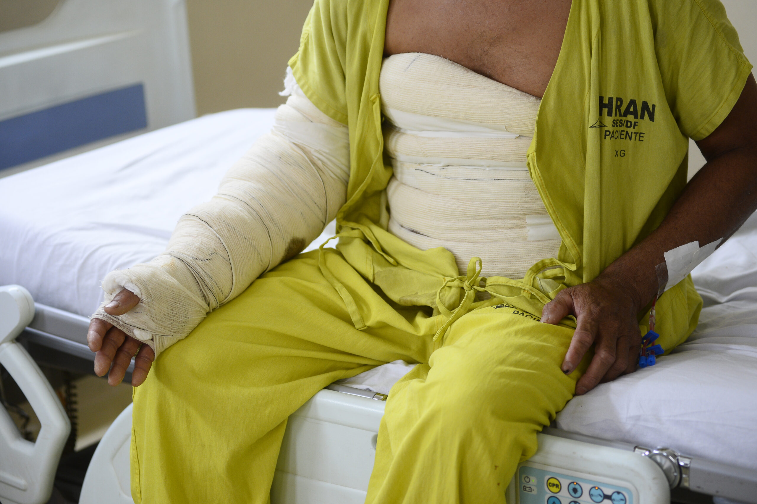 Hran reforça atendimento a vítimas de queimaduras no Junho Laranja