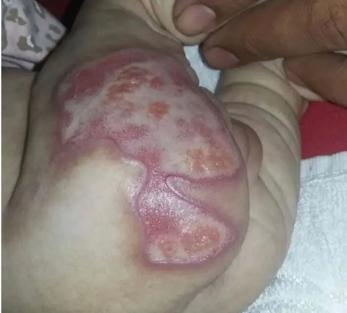Bebê queimada em hospital de Goiás espera Justiça há 8 anos